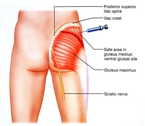 5 unglaubliche ares steroide Beispiele