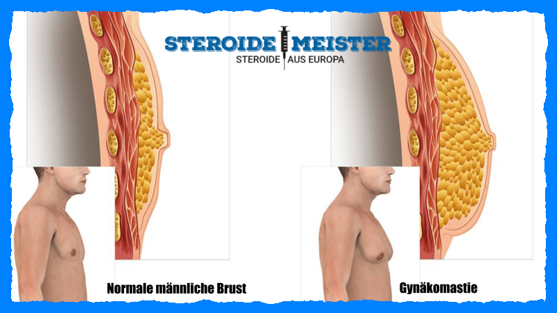 Testosteron vs Trenbolon: Was ist besser? 2 Bild eines Patienten mit Gynäkomastie, das eine sichtbare Vergrößerung des Brustgewebes zeigt